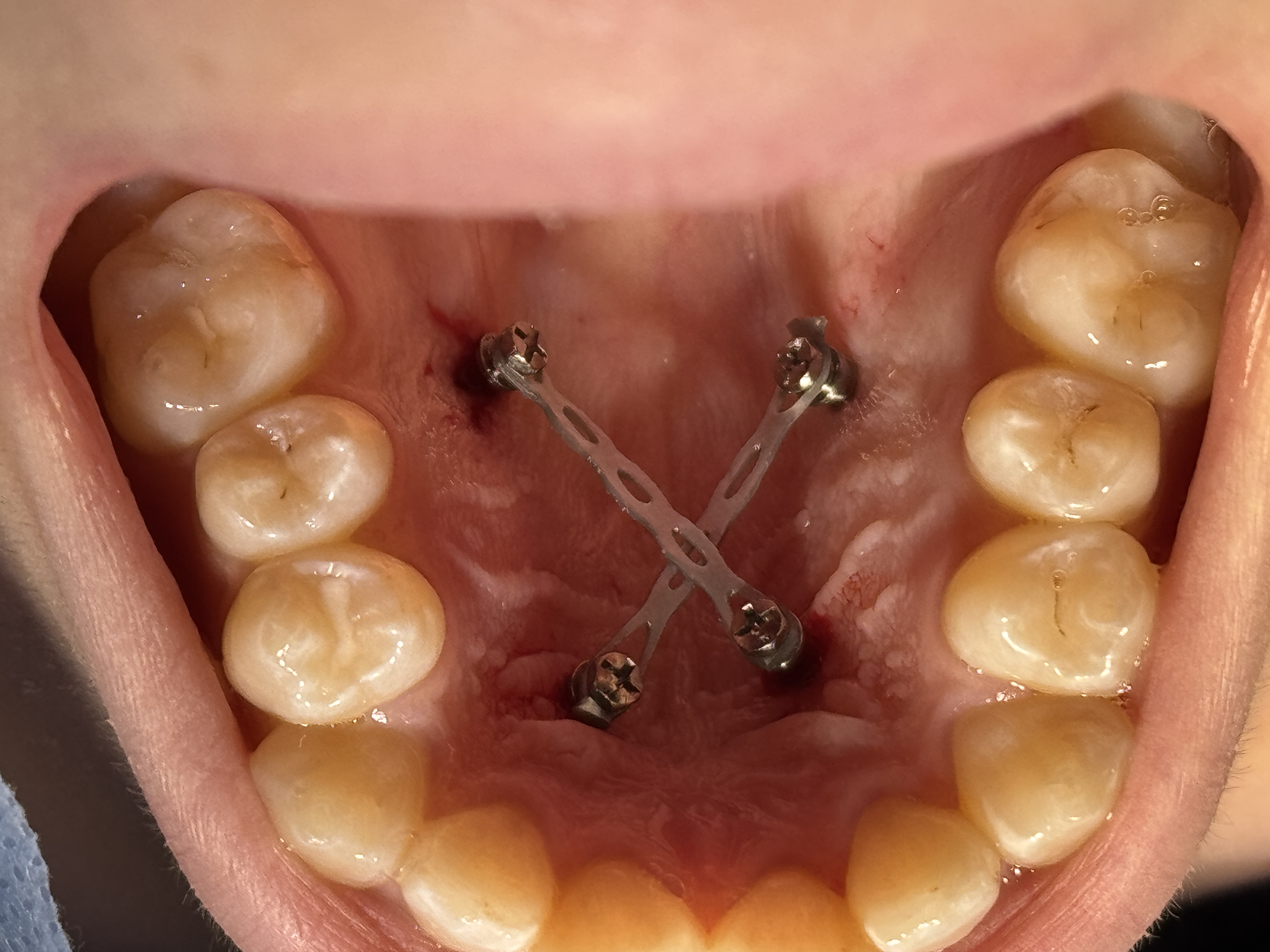 Microtornillos de anclaje